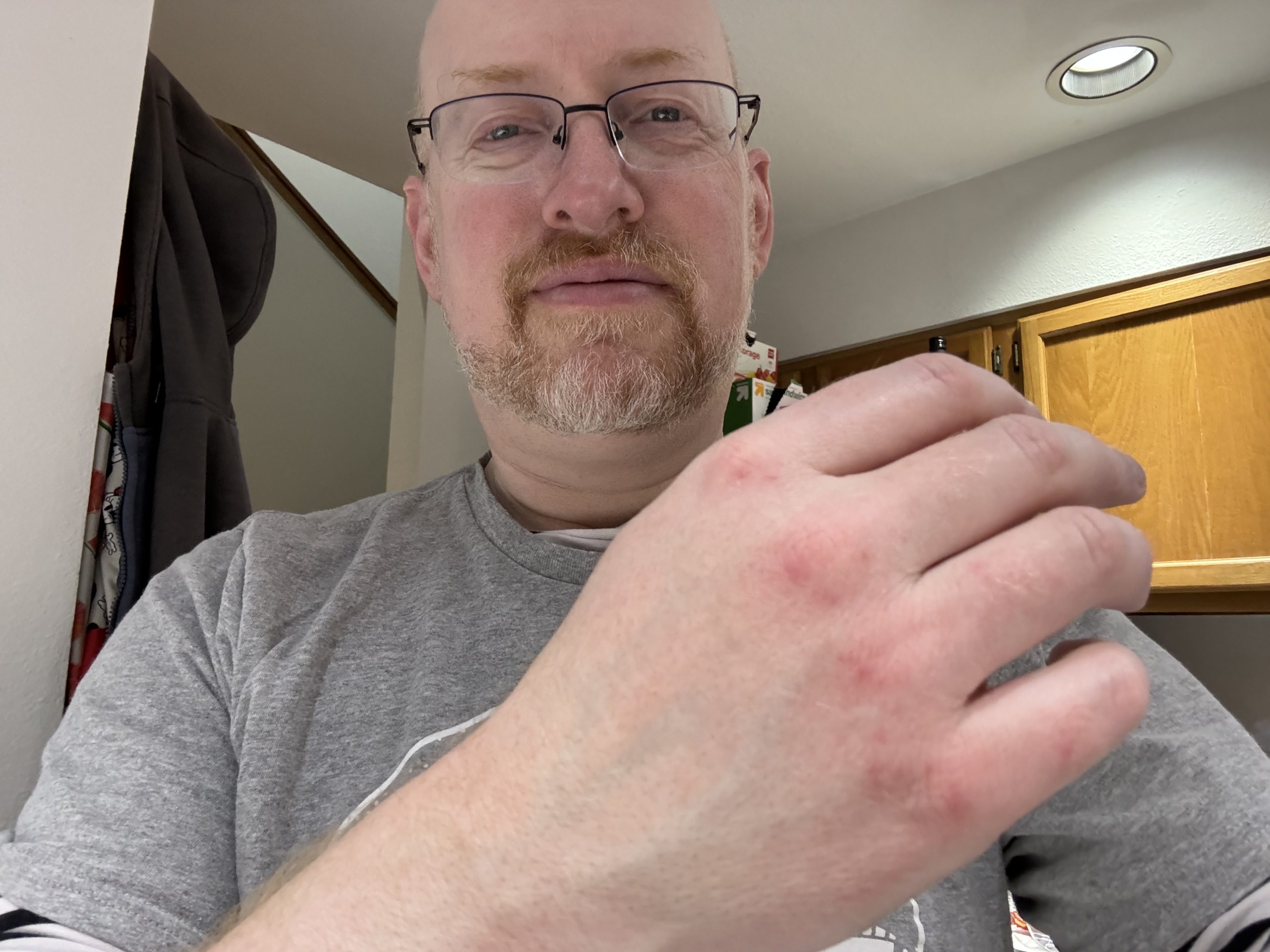 Me in our kitchen, holding the back of my right hand up to the camera to show my red and raw knuckles.